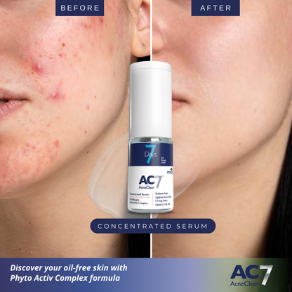 AcneClear7 Days Concentrated Serum (10ml)